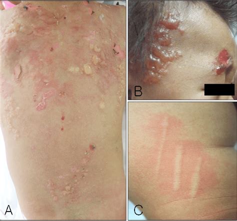 A B Multiple Tense Bullae And Erosions Developed With Peau