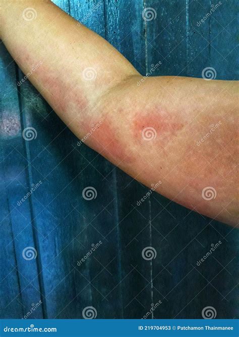 Close Up Shot Of Scars Red Itchy Rashes On Arms Of Asian Women Skin