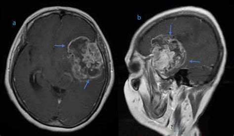 Cureus A High Grade Glioma Of Temporal Lobe In A Child A Case Report