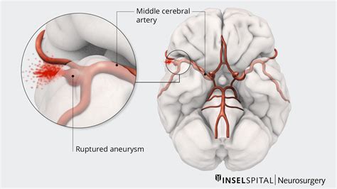 Ruptured Aneurysm And Subarachnoid Haemorrhage Neurosurgery