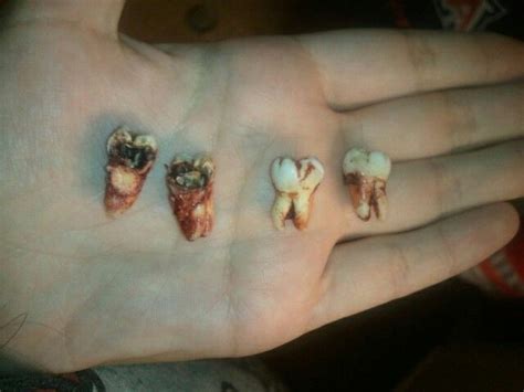 My Wretched Wisdom Teeth And The Ones They Ruined While Trying To Grow