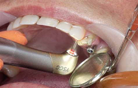 Sanderslaser Operatoria Dental