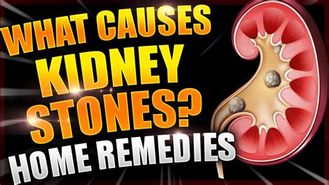What Causes Kidney Stones How To Get Rid Of Kidney Stones With Home