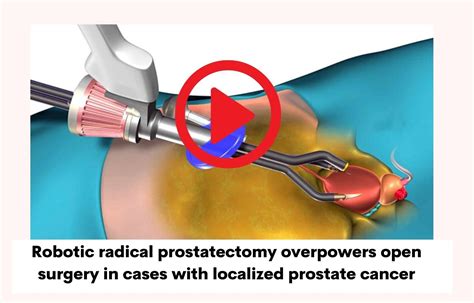 Robotic Radical Prostatectomy Overpowers Open Surgery In Cases With Localized Prostate Cancer