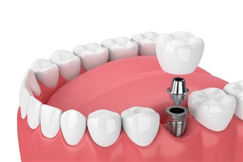 Dental Implants Cosmetic Dentistry For Missing Teeth