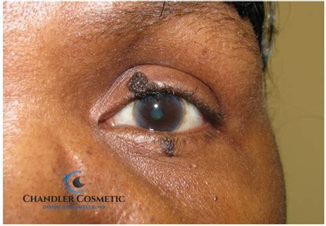 Mole On Eyelid Removed Easily Dr Chandler