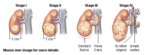 Renal Cancer Physiopedia