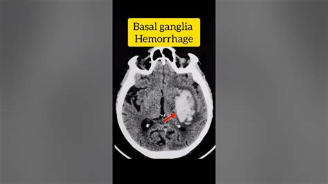 Basal Ganglia Hemorrhage Hypertension Intracerebral Bleed Ct