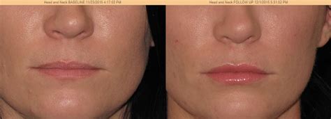 Lip Augmentation Before And After Photos Juvederm