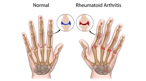 Rheumatoid Arthritis Arthritis Treatment Center