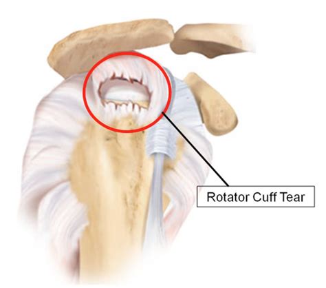 Rotator Cuff Tear And Impingement All You Need To Know My Xxx Hot Girl