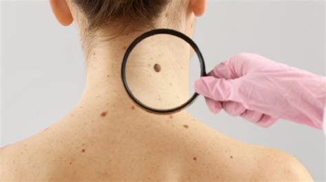 What Does Melanoma Look Like 5 Skin Cancer Signs To Watch For Video