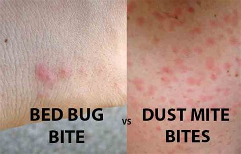 Dust Mite Vs Bed Bug Bites Pestbugs