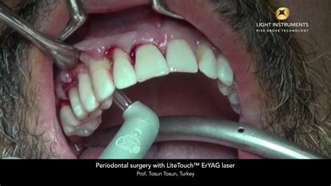 Periodontal Surgery Ii With Litetouch™ Eryag Laser Youtube