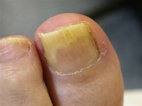 Home Treatments For Onychomycosis Are They Any Good
