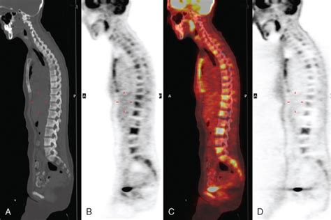 Identifying Bone Metastases Radiology Key