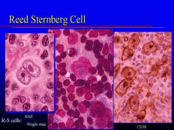 Linfoma di Hodgkin - Ematologia e oncologia - Manuali MSD ...