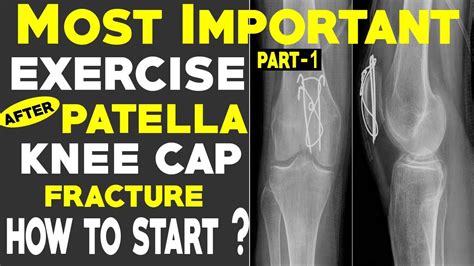 Most Important Exercise After Patella Fracture Patella Fracture