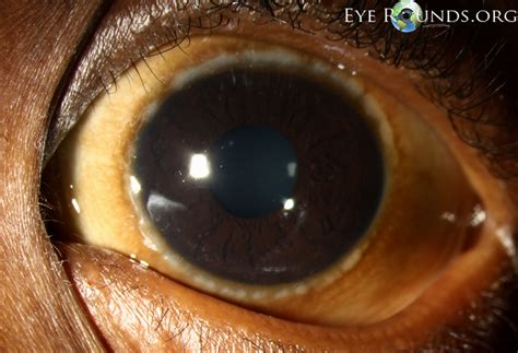Vernal Keratoconjunctivitis Online Ophthalmic Atlas