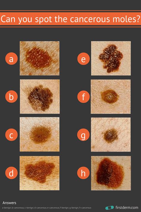 Can You Spot The Cancerous Mole Online Dermatology Cancerous Moles