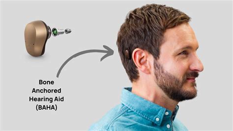 Bone Anchored Hearing Aids Baha Vs Cochlear Implants And Traditional Hearing Aids