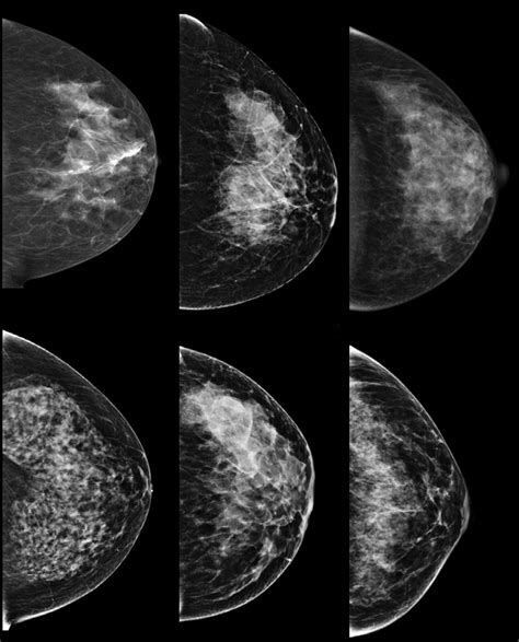 breast density clinical implications and assessment methods radiographics
