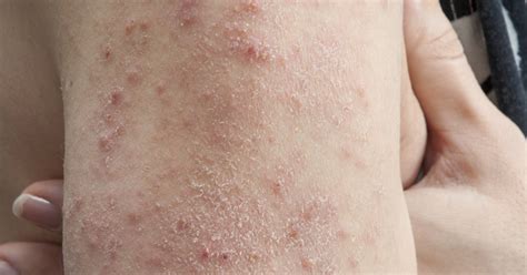 Pictures Of Skin Rashes Skin Rashes Kids Causes And Methods Of