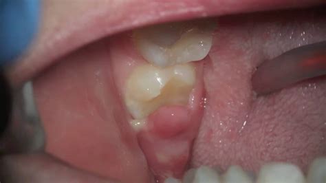 Pericoronitis Infection