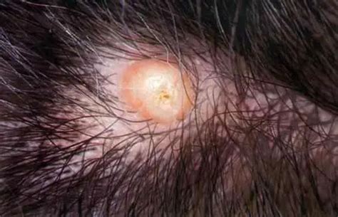 Ingrown Hair On Scalp Head With Cyst Bump Causes And Removal Treat