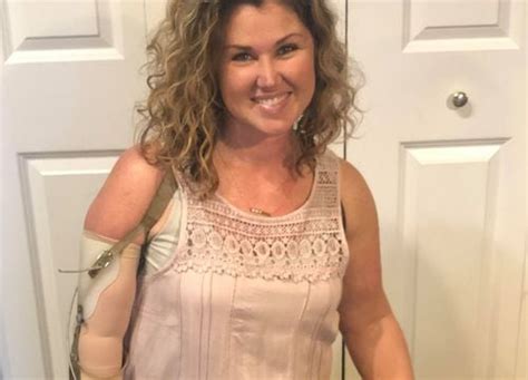 Woman With Prosthetic Arm Asks Apple To Make Its Watch Accessible