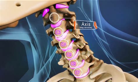 Stenoza szyjna kanału kręgowego | Leczenie kręgosłupa