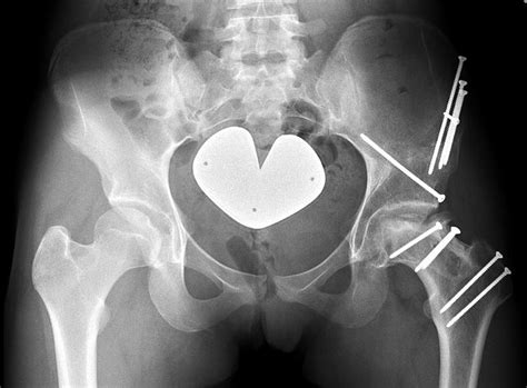 case one latest follow up anteroposterior pelvic radiograph at three download scientific