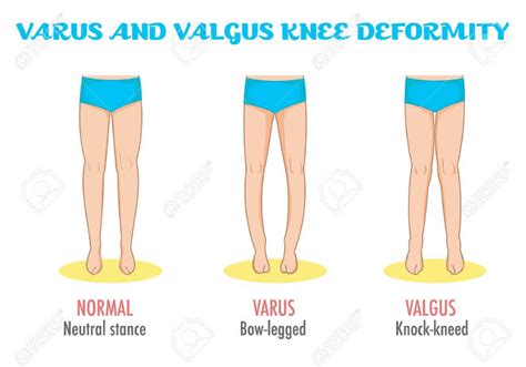Samarpan Physiotherapy Clinic Knee Valgus Deformity Overview
