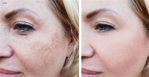 Laser For Hyperpigmentation Removal Cosmetic Surgery Tips