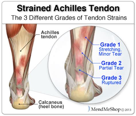 Achilles Tendon Injuries And Running Read Performance Training