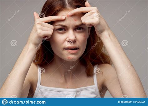 Portrait Of A Woman Squeezes A Pimple On Her Forehead Acne Cosmetology