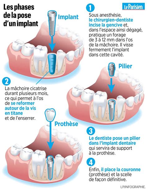 Tout Savoir Sur Les Implants Dentaires Le Parisien