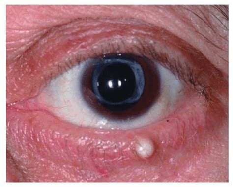 Eyelid Lesions Anesthesia Key