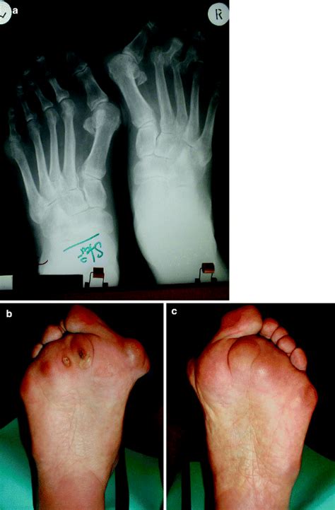 Rheumatoid Foot Reconstruction Springerlink