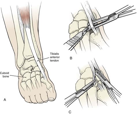 Tibialis Anterior Tendon Repair