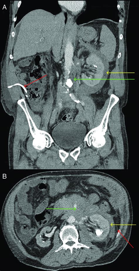 A Abdominal And B Pelvic Computed Tomography Confirming A