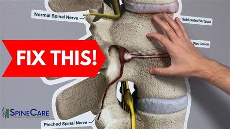 How To Fix A Bulging Disc In Your Lower Back Bulging Disc Back