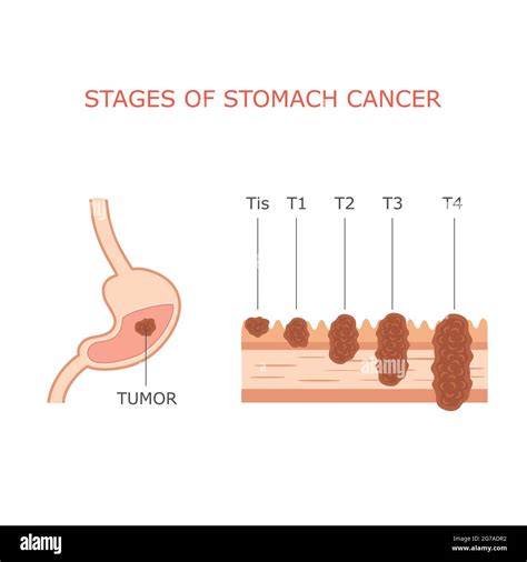 Stomach Cancer Stages Human Gastric Tumor Anatomy Digestive System