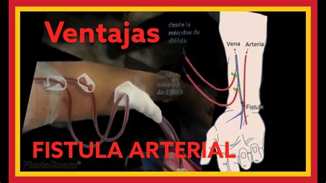 Fistula Arteriovenosa En HemodiÁlisis 🤨 Alejandra Irc Youtube