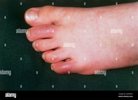 Chilblains Chilblains On The Toes Of A 6 Year Old Girl Chilblains