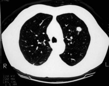 Solitary Pulmonary Nodule Background Types Of Benign Pulmonary Tumors Etiology Of Solitary