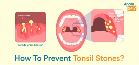 Tonsil Stones And How To Prevent Them