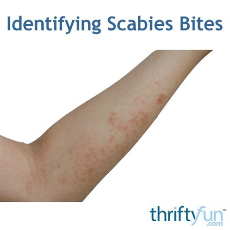 Identifying Scabies Bites Thriftyfun