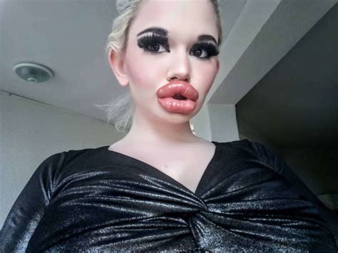 Bulgarian Girl With World’s Largest Lips Enlarged Them For The 20th Time 21 Pics