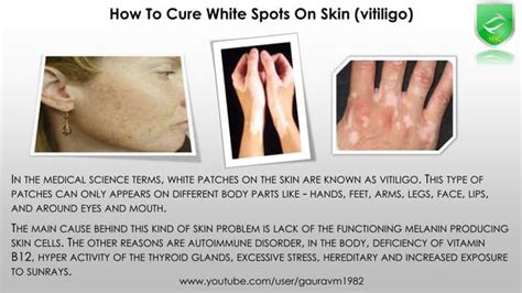How To Cure White Spot On Skin Vitiligo Treatment Naturally Ppt